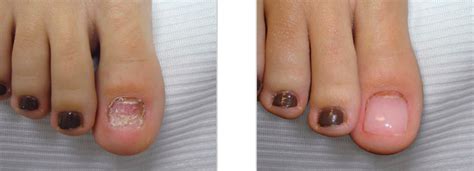 Nail Reconstruction Surgery - Nail Ftempo