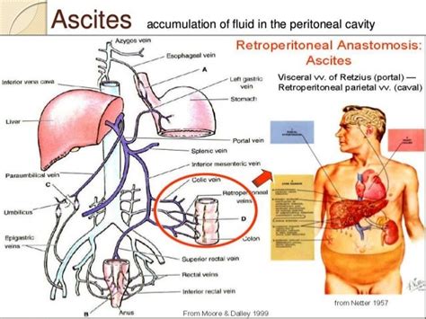 portacaval anastomosis