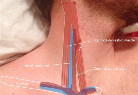 Ultrasound-Guided Venous Access | CDEM Curriculum