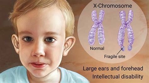 Fragile X syndrome causes, inheritance, symptoms, diagnosis & treatment