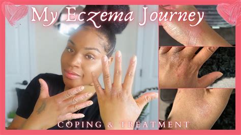 How I’m Getting My Chronic Eczema Under Control: Dupixent Journey ...