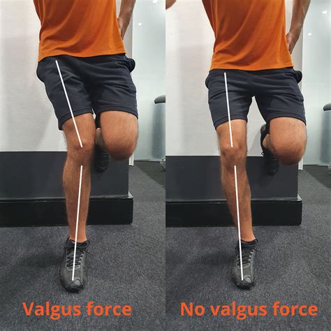 What is Valgus Collapse? Knee valgus explained (2021) | Infinite Health Physio