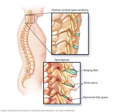 Cervical Spondylosis | ReLiva Physiotherapy & Rehab