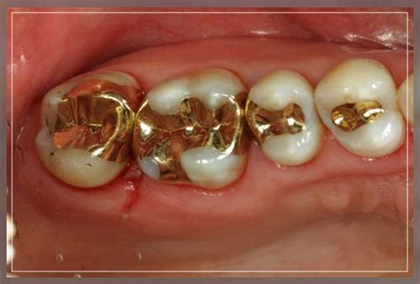 Gold Fillings: Pros and Cons - Engiomed