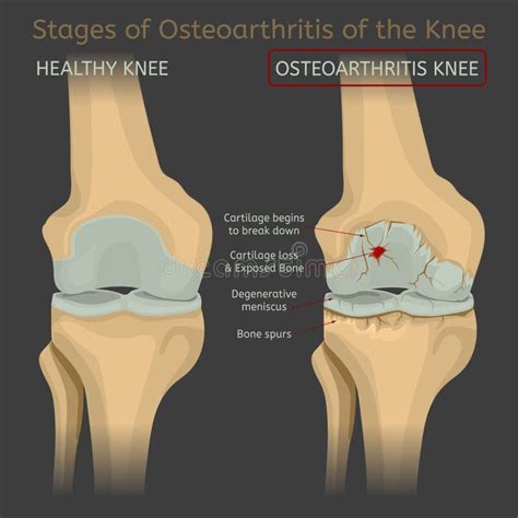 Stages of Knee Osteoarthritis (OA). Stock Vector - Illustration of medicine, movement: 45644007