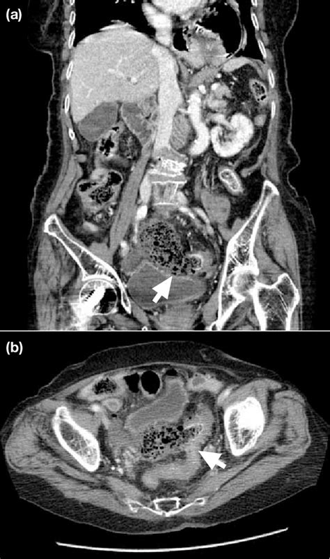 Figure 1 from Stercoral Perforation of the Sigmoid Colon with Faecal Peritonitis: Report of t wo ...