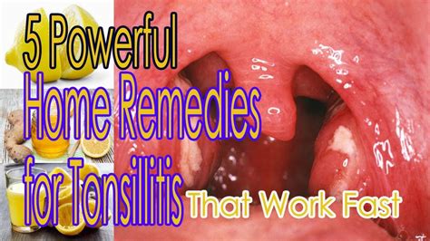 5 Powerful Home Remedies for Tonsillitis That Work Fast - YouTube