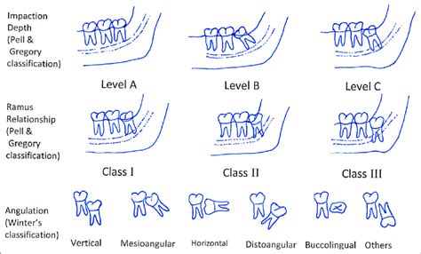 The impaction depth, ramus relationship, and angulation classification ...