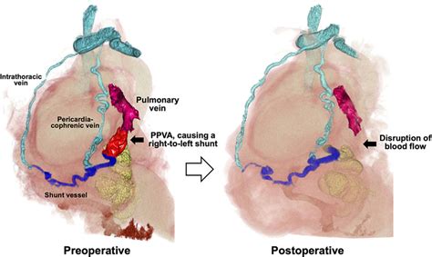 Surgical… | The American Association for Thoracic Surgery | AATS