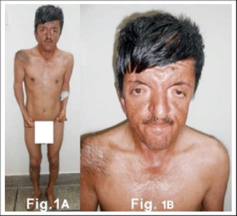 1A. Patient with Apert Syndrome. 1B. Face of the case. | Download ...