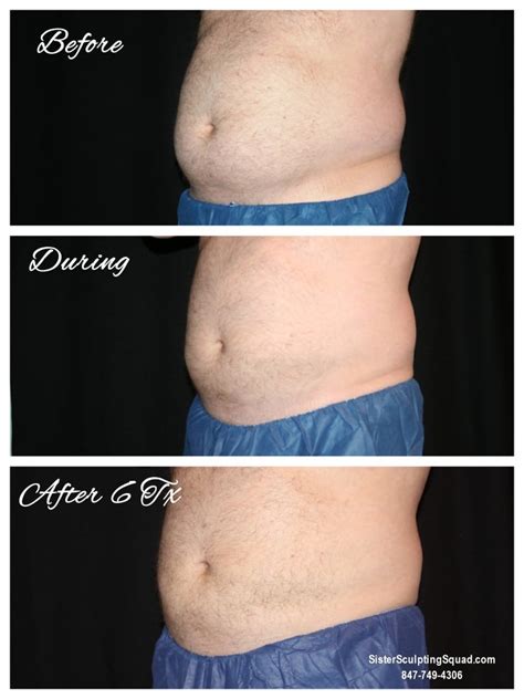 CoolSculpting Before & After Photos - Riverside Medical S.C