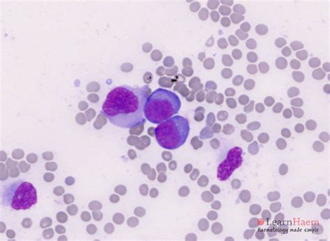 Multiple Myeloma - LearnHaem | Haematology Made Simple