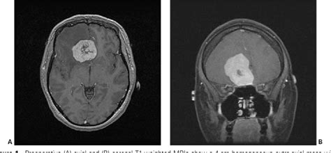 Figure 1 from Teflon granuloma of the skull base: a complication of endonasal brain surgery ...