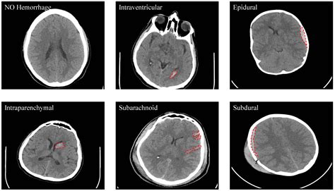 Brain Ct Scan Report Sample Pdf - barebonestory