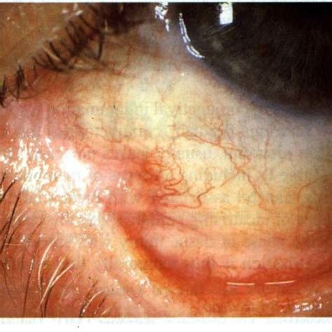 Acute ocular pemphigoid in a 73-year-old man with a history of... | Download Scientific Diagram