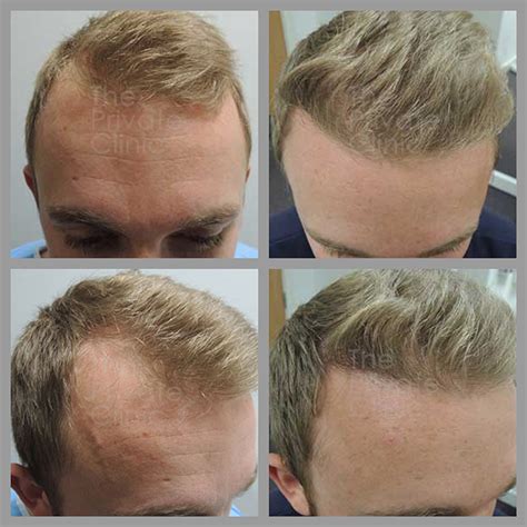 Hair Transplant: Who is likely to feel it wasn't a good idea? Donovan Hair Clinic