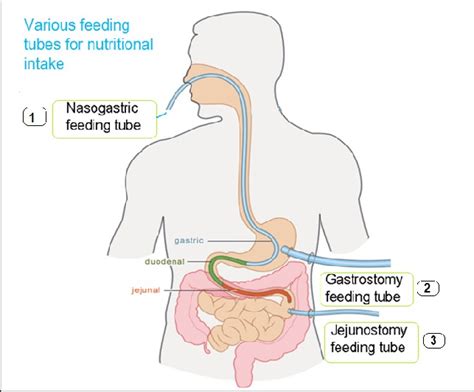 Food is directly injected/infused into different locations through ...