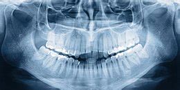 OPG (Orthopantomographie) - Panorama-Röntgenbilder