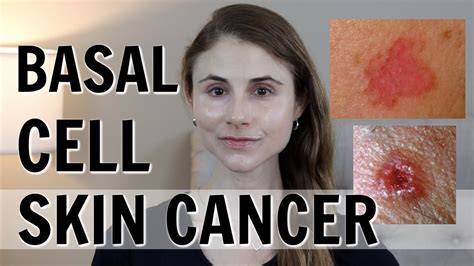 Images Of Basal Cell Skin Cancer