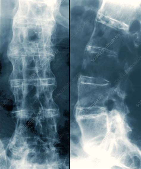 Spine in ankylosing spondylitis, X-ray - Stock Image - C029/9983 ...