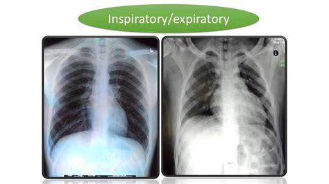 introduction radiology chest xray - YouTube