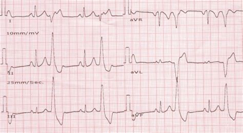 Ventricular ectopic bigeminy – All About Cardiovascular System and Disorders