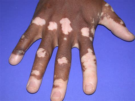 What is Vitiligo? – Naturally Healthy Skin