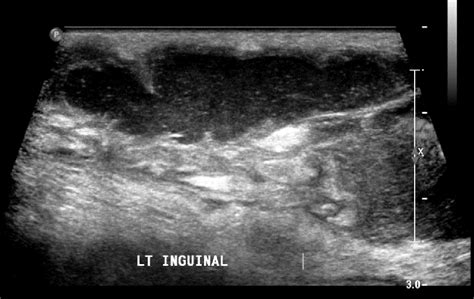 Ultrasound groin shows multiple lymph nodes with collection at... | Download Scientific Diagram