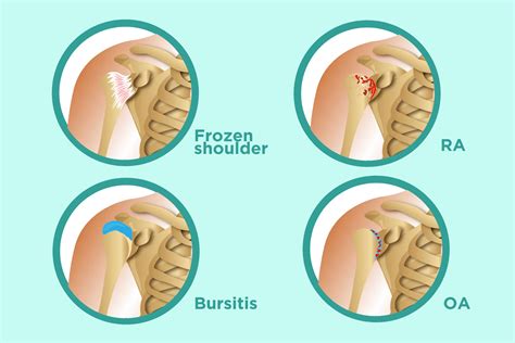 Rheumatoid Arthritis of the Shoulder | USA Spine Care & Orthopedics