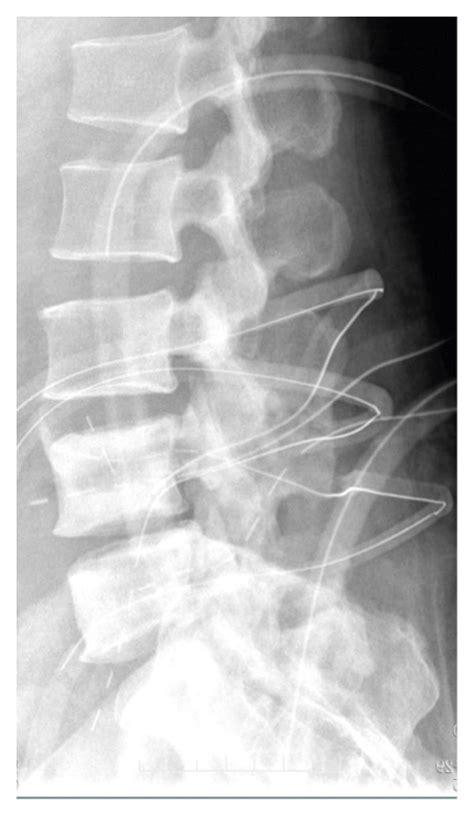 (a, b) Three years after L4-5 Dynesys dynamic internal fixation,... | Download Scientific Diagram