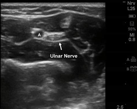 Ulnar Nerve Block Ultrasound