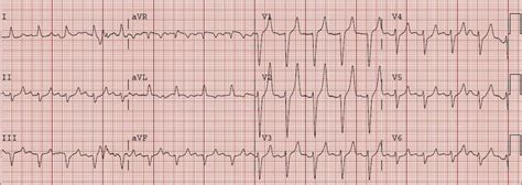 Dr. Smith's ECG Blog: HyperKalemia with Cardiac Arrest. Peaked T waves: Hyperacute (STEMI) vs ...