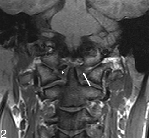 Apical Ligament Mri