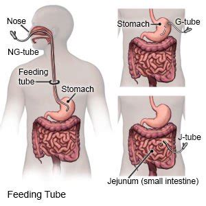 Tube Feeding (Discharge Care)