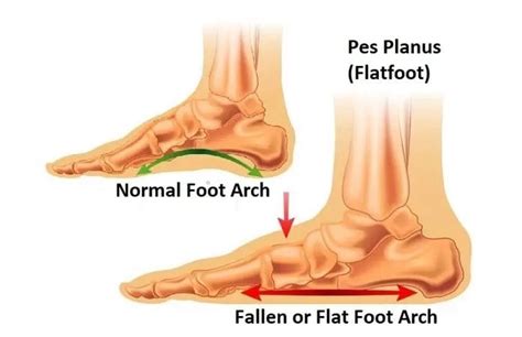 Flatfoot (Pes Planus) – Facts to Know – New Life Ticket