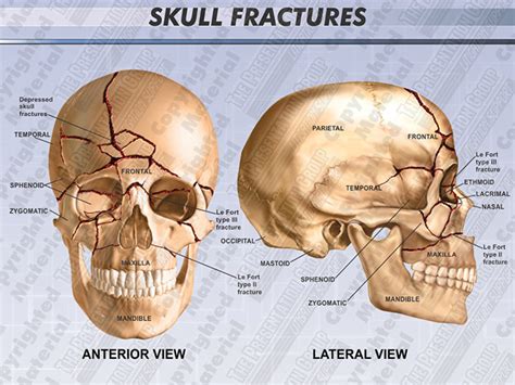 Skull Fractures | Medical Legal Illustration