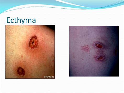 PPT - IMPETIGO and ECTHYMA PowerPoint Presentation, free download - ID:2103356