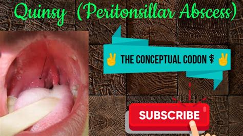 Peritonsillar Abscess Identification And Treatment – Otosection