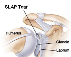 SLAP Tear Symptoms & Causes,SLAP Tear shoulder surgery | JaipurJoints