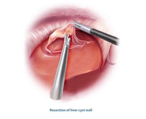 Liver Treatment | Liver Surgery Perth | Perth Liver Specialists & Surgeons