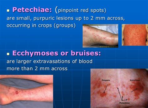 purpura vs. ecchymosis : 네이버 블로그