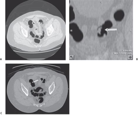 93 Sigmoid Colonic Polyp | Radiology Key