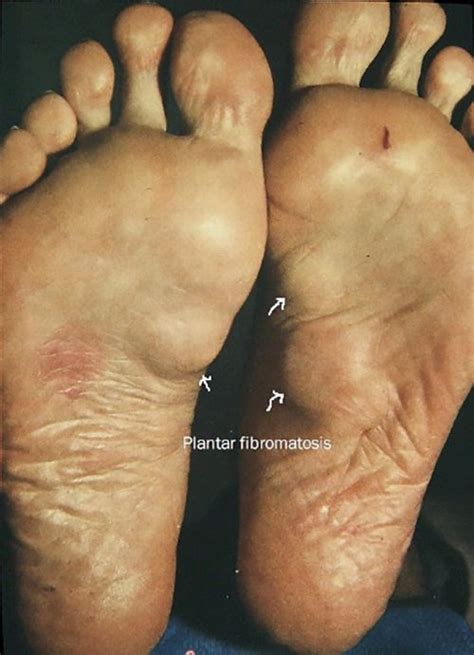 Plantar Fibromatosis | Causes and treatment options - Printer friendly ...