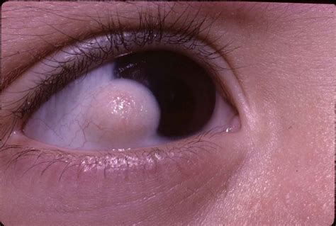 Eyeball Bubble: Types, Symptoms, and Medical Care