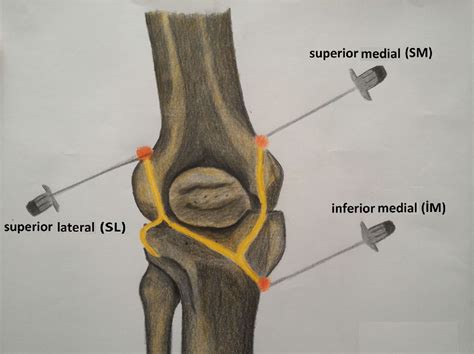 Figure 1 from Which imaging method should be used for genicular nerve radio frequency ...