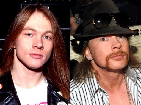 Chatter Busy: Axl Rose Plastic Surgery