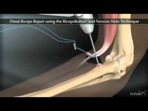 Distal Biceps Repair Animation - YouTube