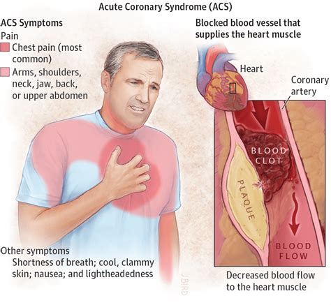 Procalcitonin: A new biomarker for the cardiologist | BioVendor R&D