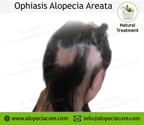 Ophiasis Alopecia Areata