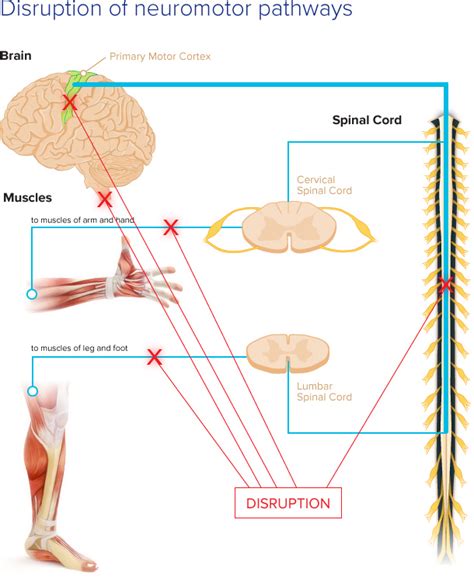 Disrupted Neural Pathways – PathMaker Neurosystems